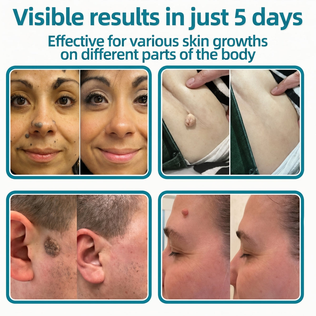 🇬🇧✅𝐇𝐞𝒂𝒍𝗿𝗶𝙯𝙚®2-in-1 Microneedle & Hydrocolloid Patch💫| Removes Raised Moles, Acne, Flat Warts & Skin Tags | Helps Improve Wrinkles, Scars & Blemishes | Invisible Patches for Face & Body