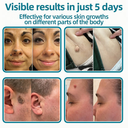 🇬🇧✅𝐇𝐞𝒂𝒍𝗿𝗶𝙯𝙚®2-in-1 Microneedle & Hydrocolloid Patch💫| Removes Raised Moles, Acne, Flat Warts & Skin Tags | Helps Improve Wrinkles, Scars & Blemishes | Invisible Patches for Face & Body