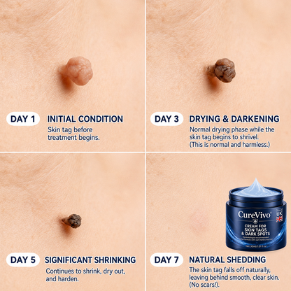 👍𝗖𝘂𝗿𝗲𝗩𝗶𝘃𝗼® 𝟕-𝐃𝐚𝐲 𝐒𝐤𝐢𝐧 𝐓𝐚𝐠 & 𝐒𝐩𝐨𝐭 𝐑𝐞𝐦𝐨𝐯𝐚𝐥 𝐂𝐫𝐞𝐚𝐦 (𝐏𝐚𝐢𝐧𝐥𝐞𝐬𝐬 𝐅𝐨𝐫𝐦𝐮𝐥𝐚 – 𝐍𝐨 𝐒𝐜𝐚𝐫𝐬)