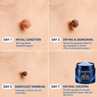 🇬🇧𝗖𝘂𝗿𝗲𝗩𝗶𝘃𝗼® 𝟕-𝐃𝐚𝐲 𝐒𝐤𝐢𝐧 𝐓𝐚𝐠 & 𝐒𝐩𝐨𝐭 𝐑𝐞𝐦𝐨𝐯𝐚𝐥 𝐂𝐫𝐞𝐚𝐦 (𝐏𝐚𝐢𝐧𝐥𝐞𝐬𝐬 𝐅𝐨𝐫𝐦𝐮𝐥𝐚 – 𝐍𝐨 𝐒𝐜𝐚𝐫𝐬)☺️