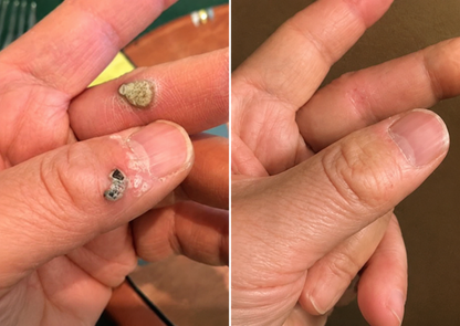 🇬🇧✅𝐇𝐞𝒂𝒍𝗿𝗶𝙯𝙚®2-in-1 Microneedle & Hydrocolloid Patch💫| Removes Raised Moles, Acne, Flat Warts & Skin Tags | Helps Improve Wrinkles, Scars & Blemishes | Invisible Patches for Face & Body