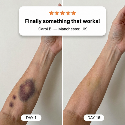 💥100K+ SOLD💕- CureVivo® Bruise Repair & Skin Strengthening Cream